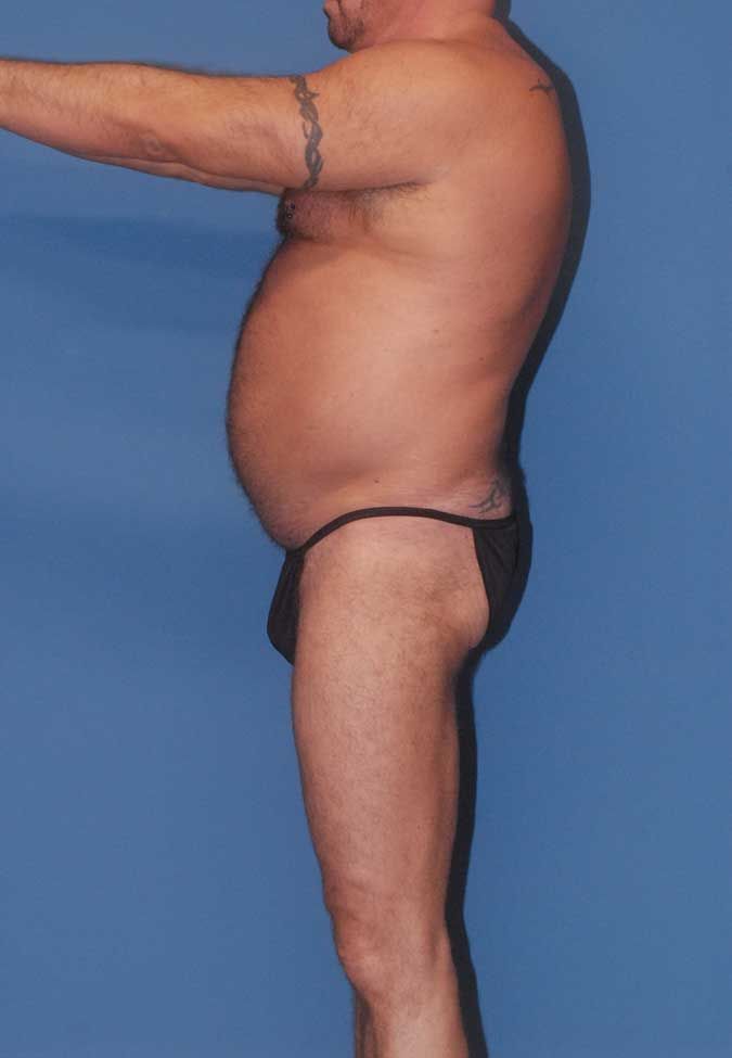 Male Body Contouring Before & After