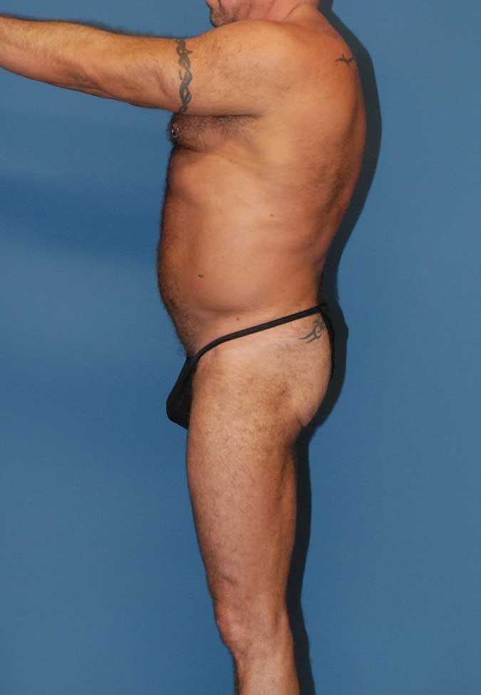 Male Body Contouring Before & After