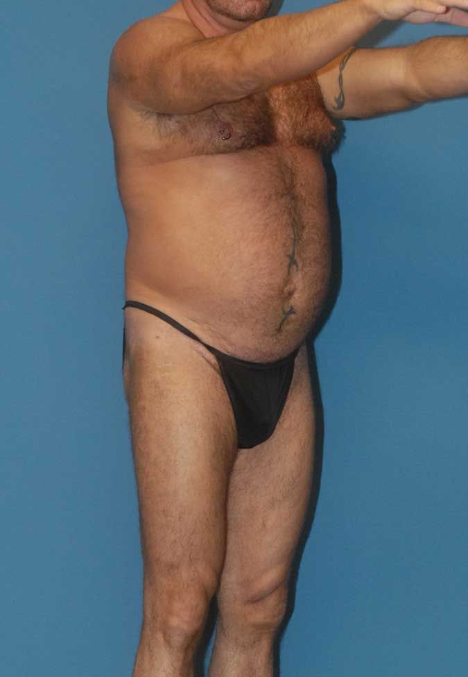 Male Body Contouring Before & After