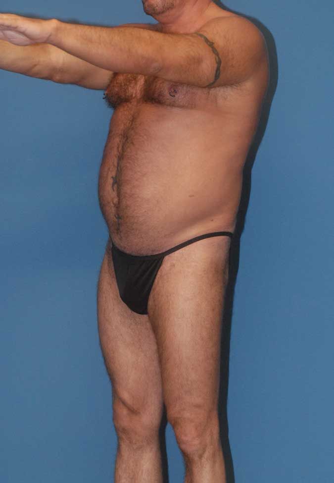 Male Body Contouring Before & After