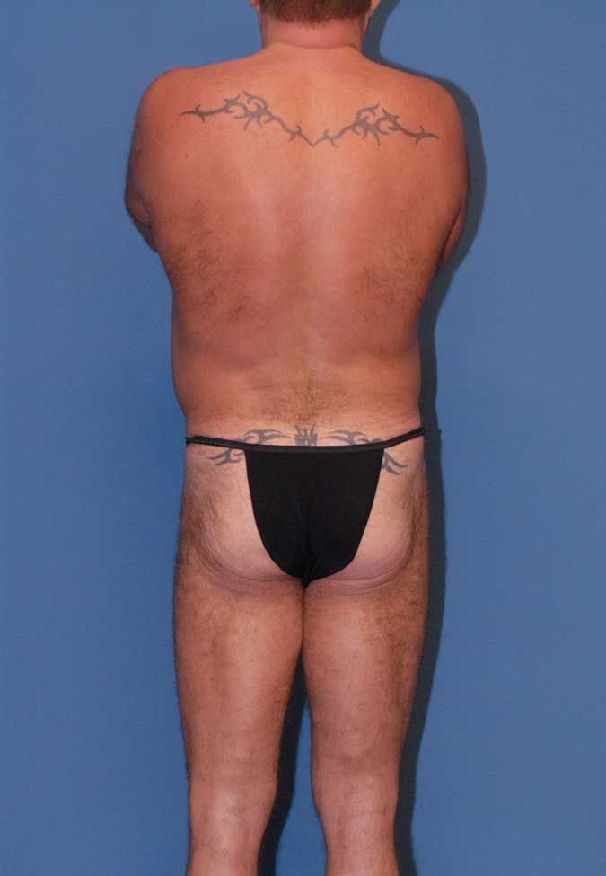 Male Body Contouring Before & After