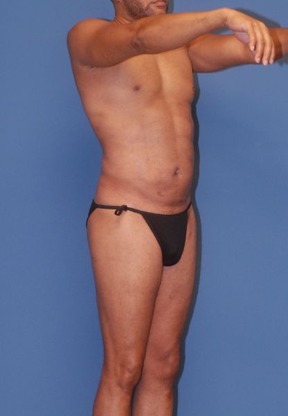 Male Body Contouring Before & After