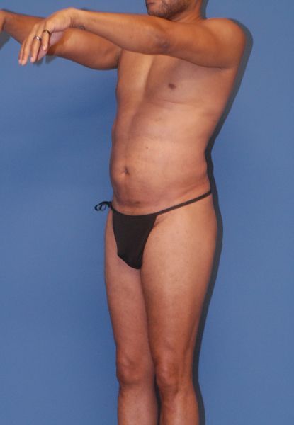 Male Body Contouring Before & After