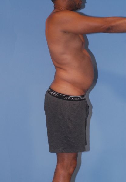 Male Body Contouring Before & After