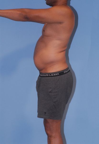 Male Body Contouring Before & After