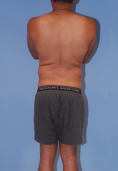 Male Body Contouring Before & After