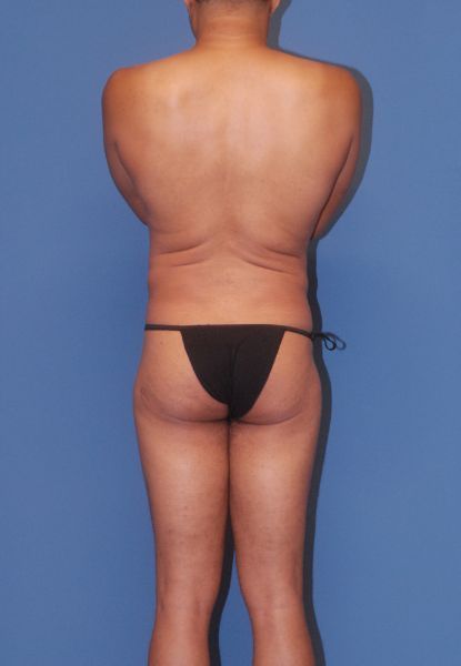 Male Body Contouring Before & After