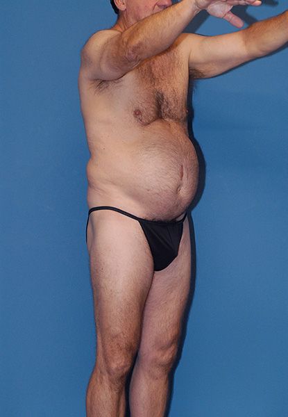 Male Body Contouring Before & After