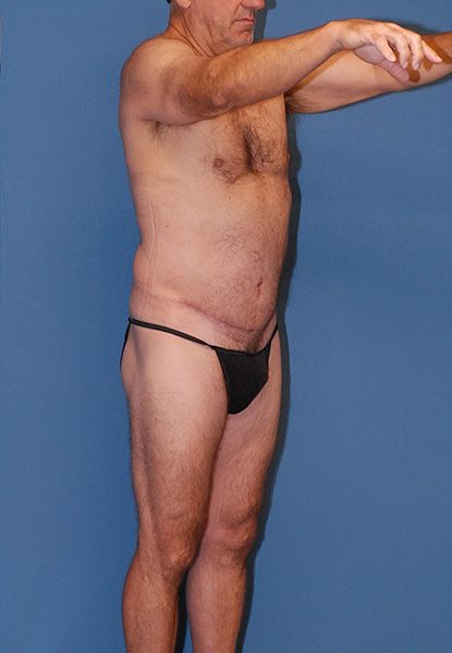 Male Body Contouring Before & After