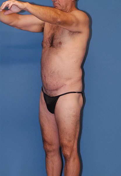 Male Body Contouring Before & After