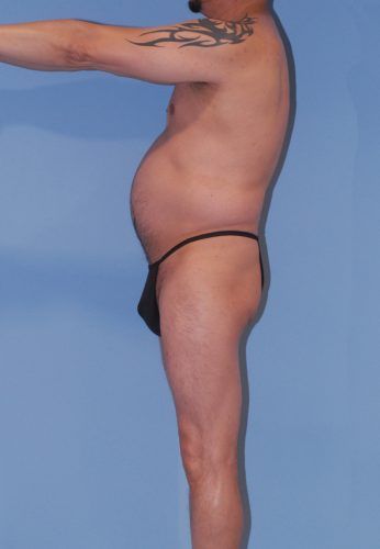 Male Body Contouring Before & After