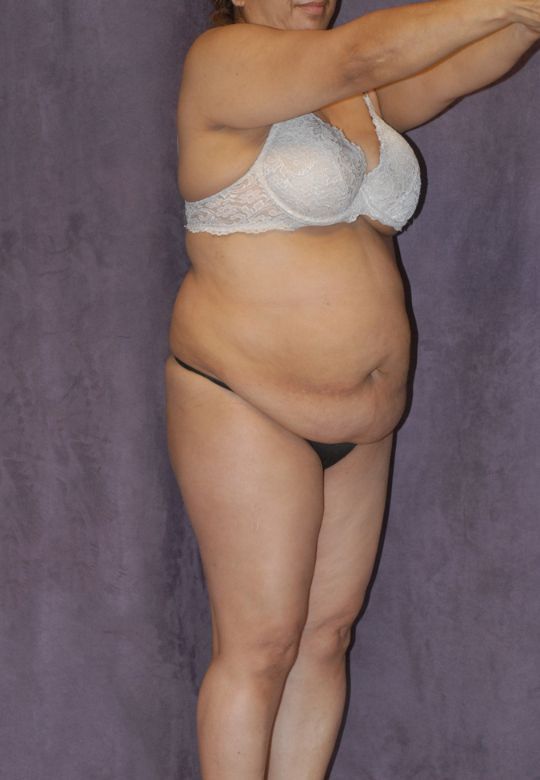 Mommy Makeover Before & After