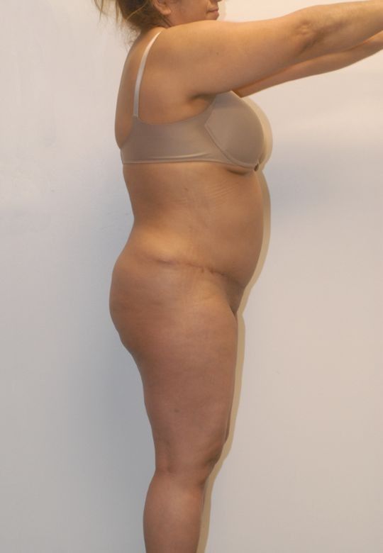 Mommy Makeover Before & After