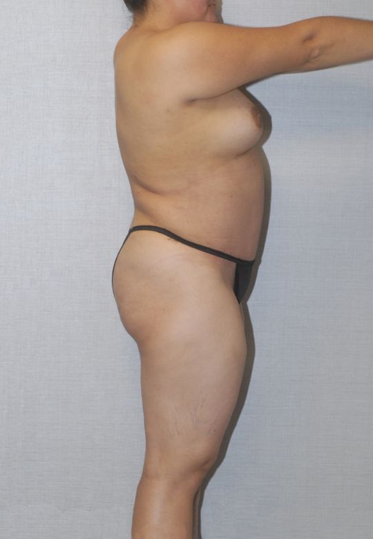 Mommy Makeover Before & After