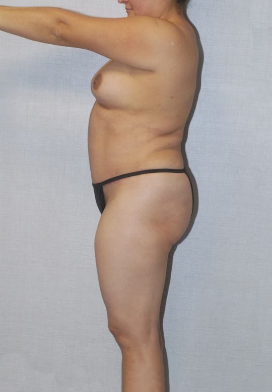 Mommy Makeover Before & After