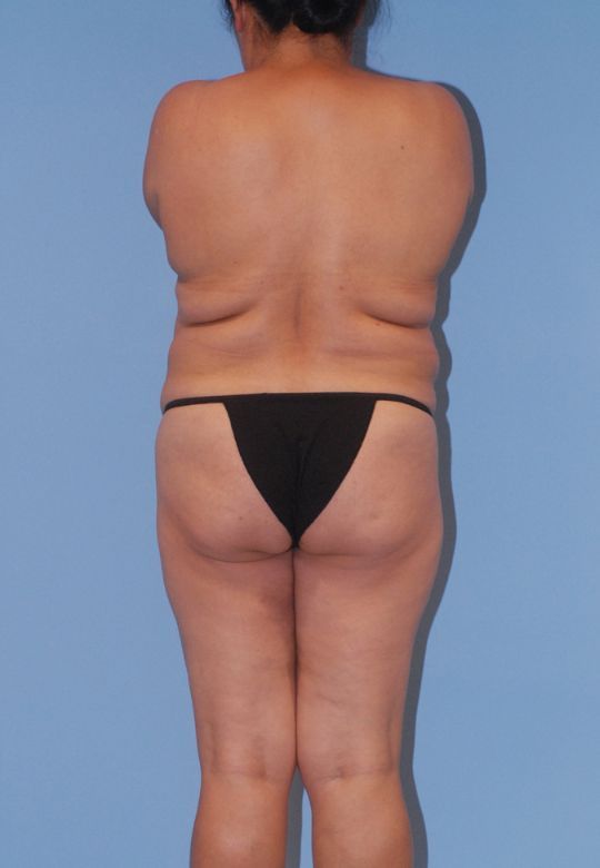 Mommy Makeover Before & After