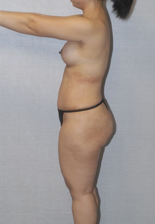 Mommy Makeover Before & After