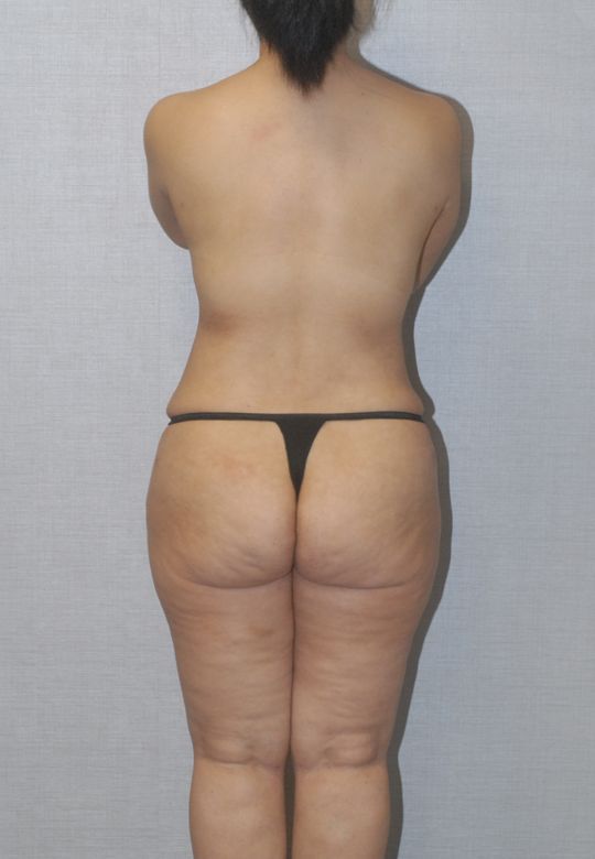 Mommy Makeover Before & After