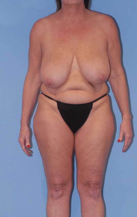 Mommy Makeover Before & After