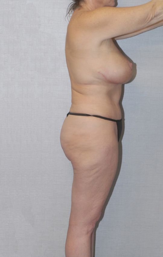 Mommy Makeover Before & After