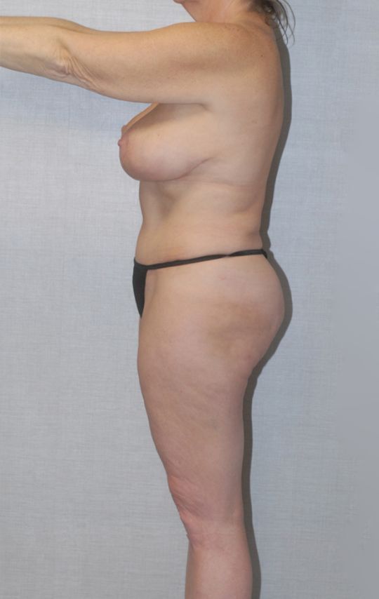 Mommy Makeover Before & After