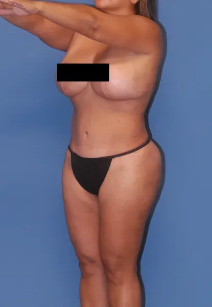 Mommy Makeover Before & After