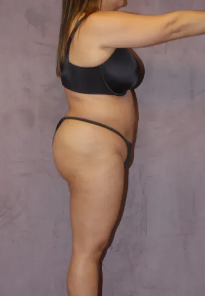 Mommy Makeover Before & After