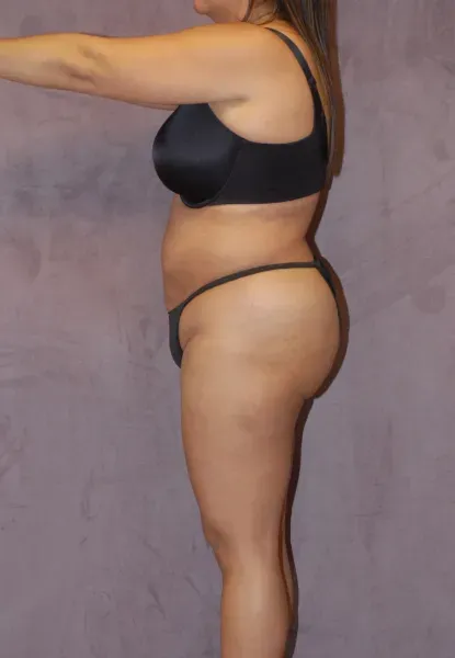 Mommy Makeover Before & After