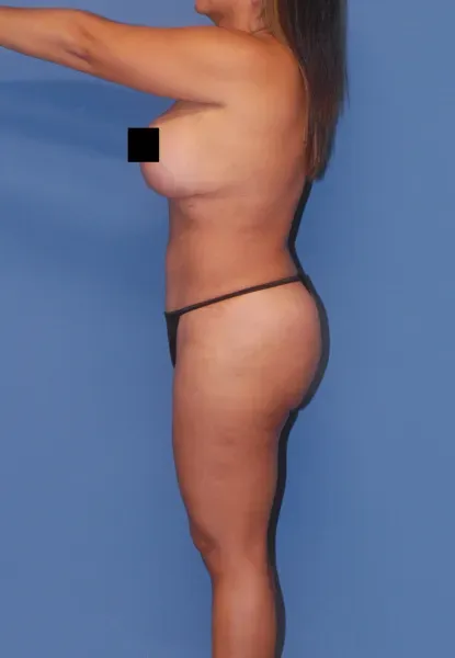 Mommy Makeover Before & After