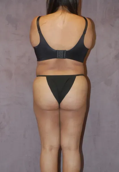 Mommy Makeover Before & After