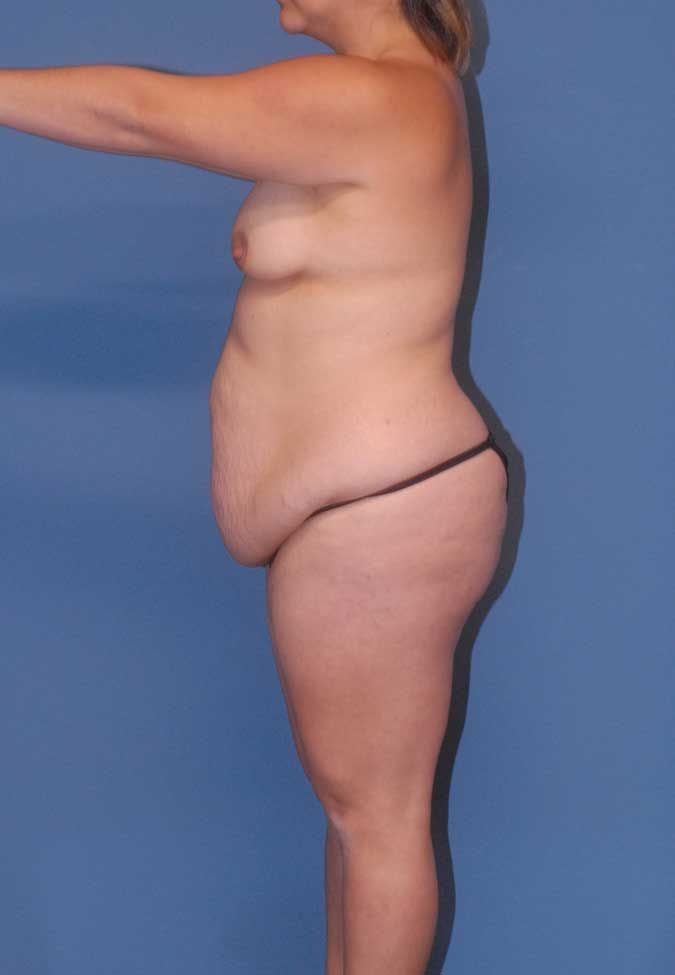 Mommy Makeover Before & After