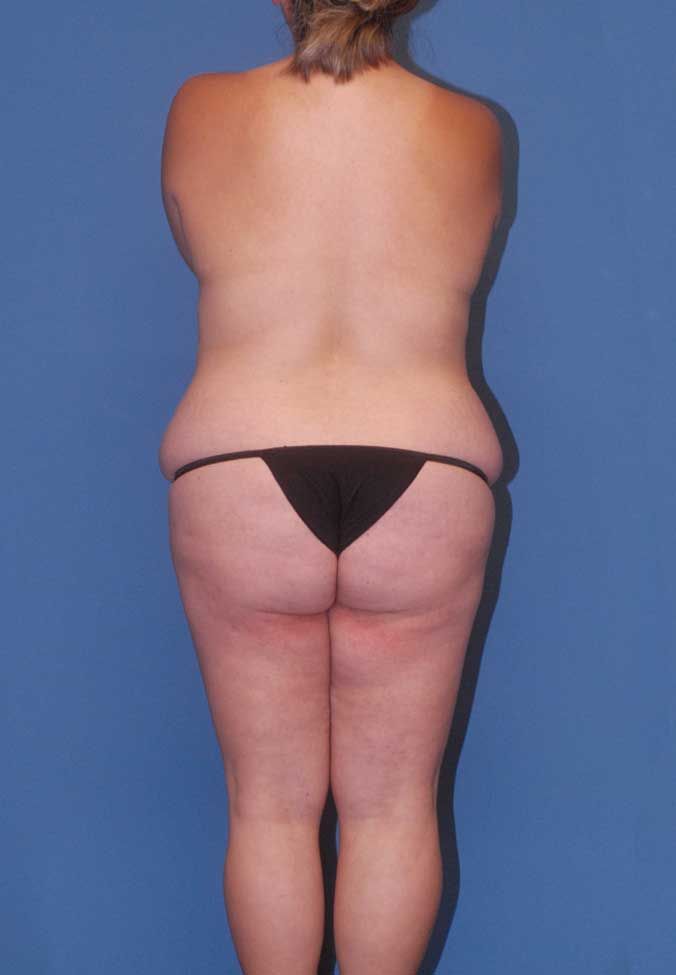 Mommy Makeover Before & After