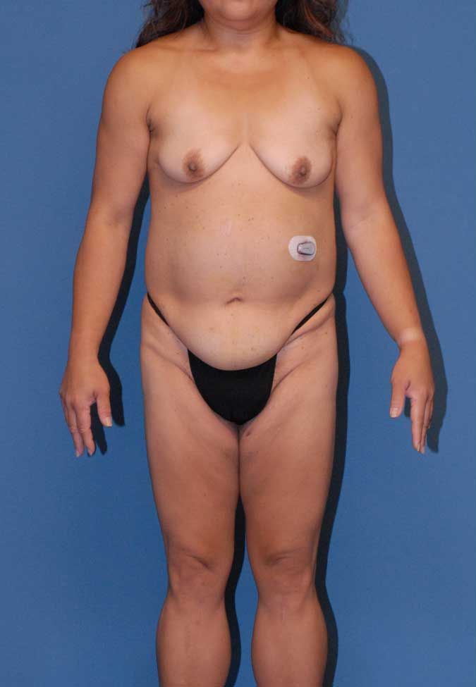 Mommy Makeover Before & After