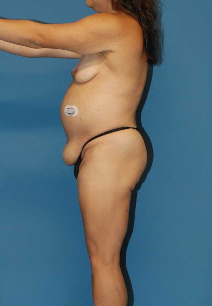 Mommy Makeover Before & After