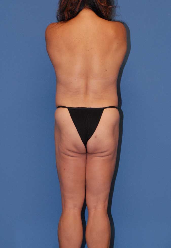 Mommy Makeover Before & After