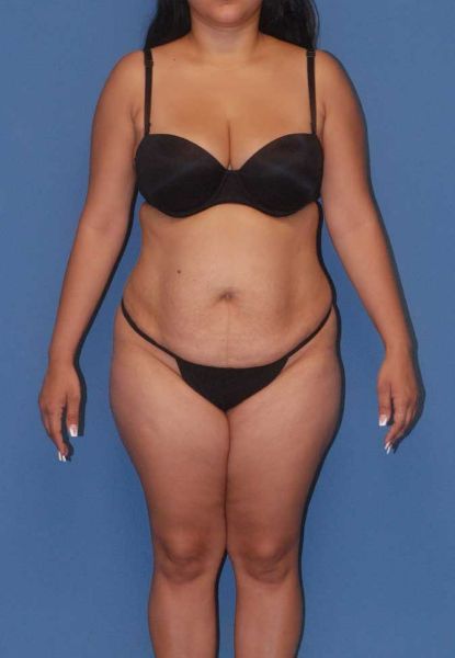 Mommy Makeover Before & After