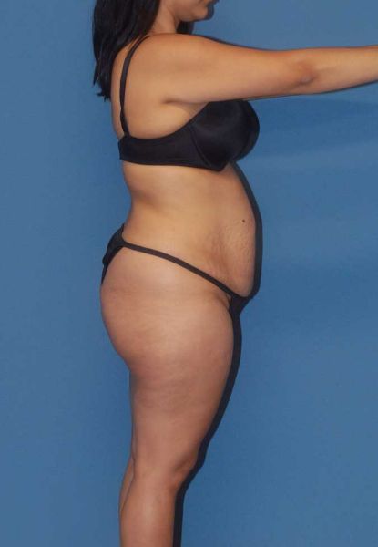 Mommy Makeover Before & After