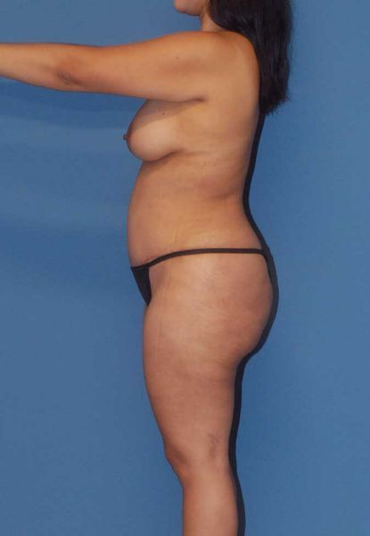 Mommy Makeover Before & After