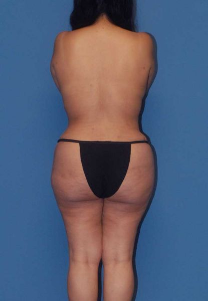 Mommy Makeover Before & After