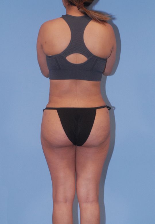 Mommy Makeover Before & After