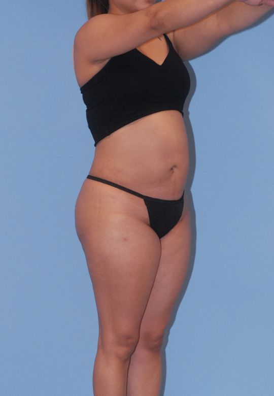 Mommy Makeover Before & After