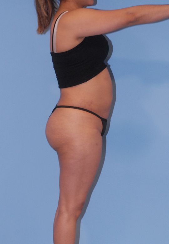 Mommy Makeover Before & After