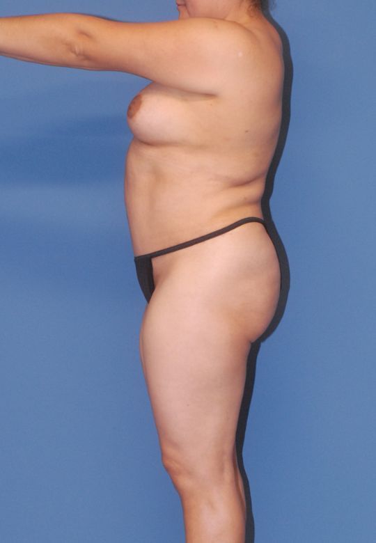 Mommy Makeover Before & After