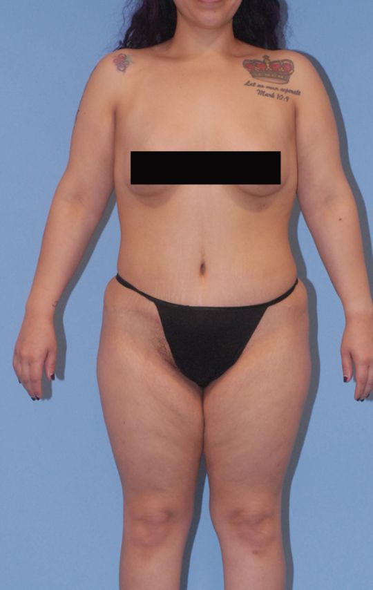 Mommy Makeover Before & After