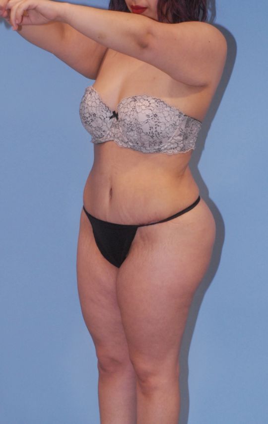 Mommy Makeover Before & After