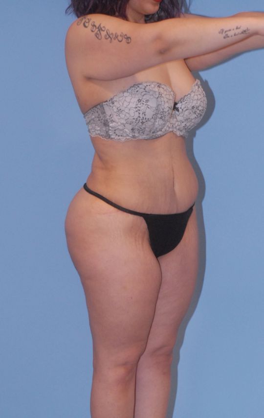 Mommy Makeover Before & After