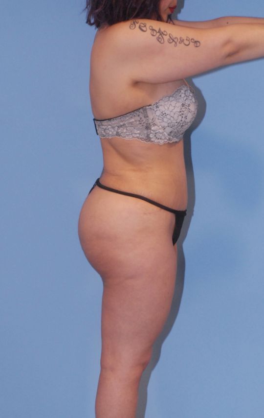 Mommy Makeover Before & After