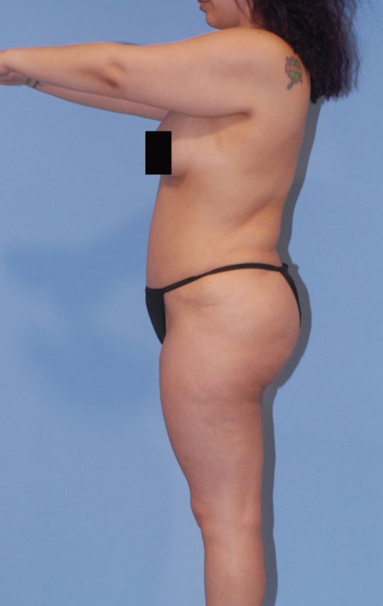 Mommy Makeover Before & After