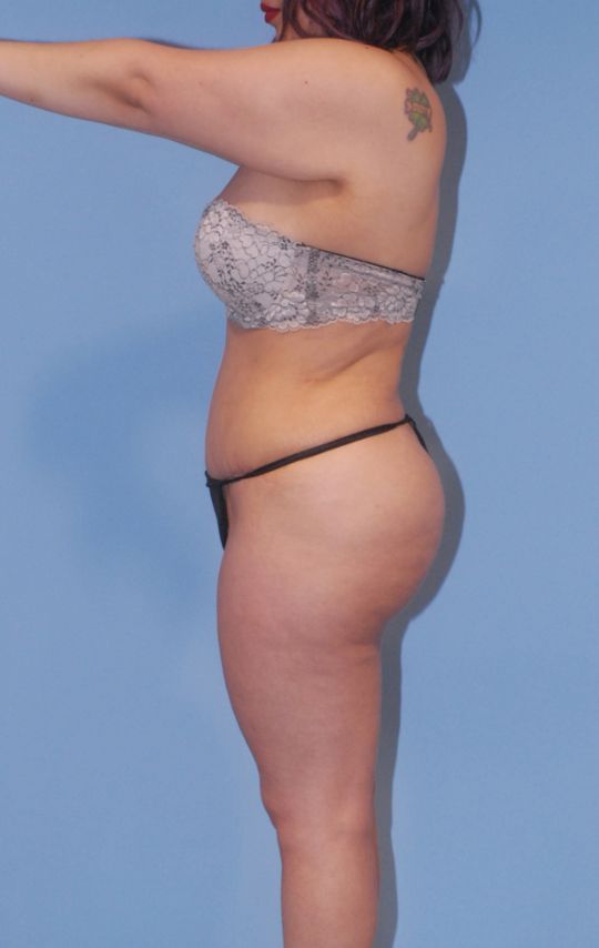 Mommy Makeover Before & After