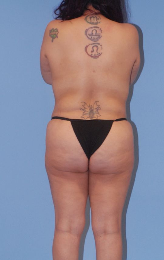 Mommy Makeover Before & After